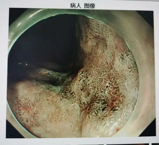 早癌筛查放大胃镜发现早癌,不仅帮助确定哪些病变可以