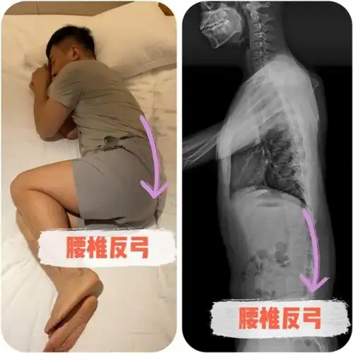 这种睡姿不仅让腰椎反弓,还会让腰部肌肉被拉长,如果你的肌肉本来就