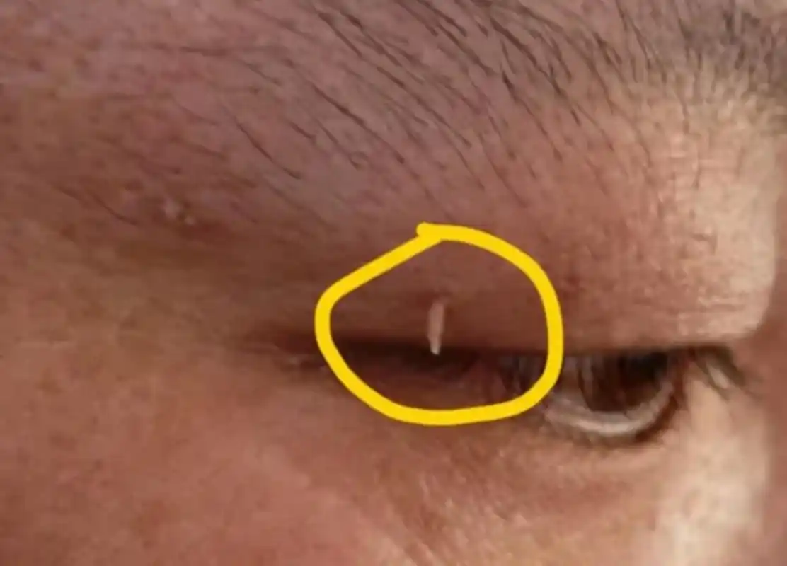 家里人说,是不是看到脏东西了 其实这叫丝状疣,是一种病毒感染引起