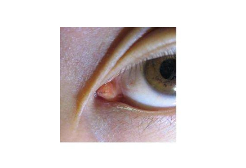 眼角长了个疙瘩图片 (42)