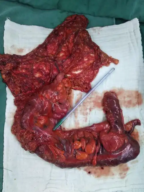 术后病理,肿瘤大约10公分,外侵严重,网膜有转移灶,右半结肠癌根治切除