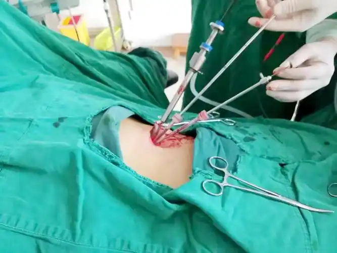 保山昌宁县人民医院微创技术再上新高度首例单孔腹腔镜下胆囊切除术获