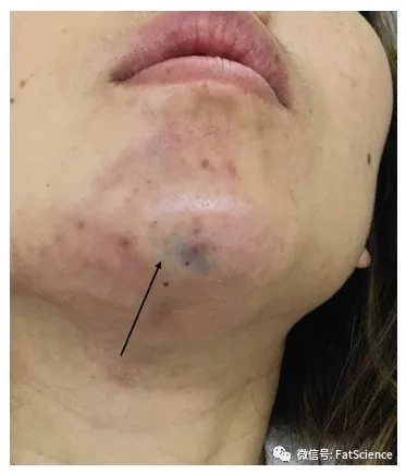 万万没想到,玻尿酸隆下巴竟栓塞