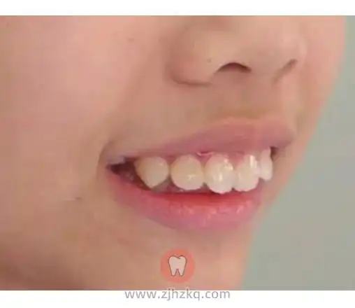 更多牙齿问题请 →在线咨询杭州儿童龅牙杭州儿童龅牙矫正杭城看牙记0