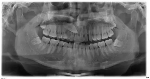 拍牙片出来后,有一个好大的牙长在牙龈里.