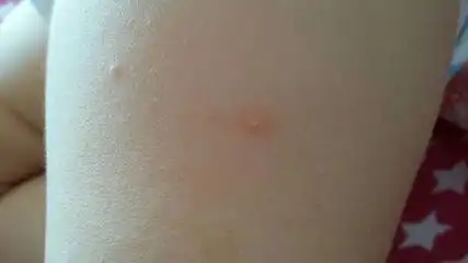 患者对尘螨的过敏程度与特应性皮炎的病情严重程度密切相关.