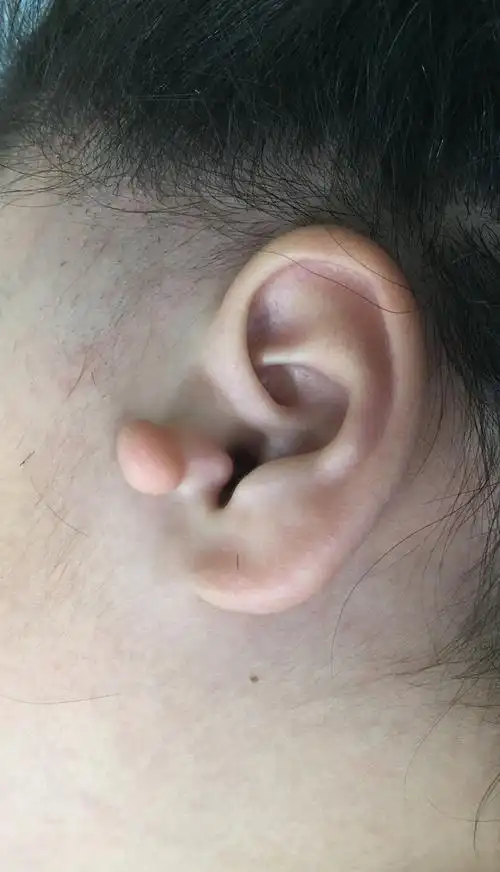 什么是附耳?_耳部整形_疾病介绍_治疗介绍 - 好大夫在线