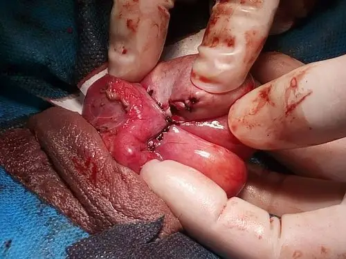 写美篇 提示:精子通过血睾屏障与免疫系统分离,睾丸破裂破坏了屏障