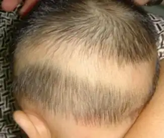 5个月的宝宝头发稀少后枕部有一圈没有头发宝宝是缺钙吗