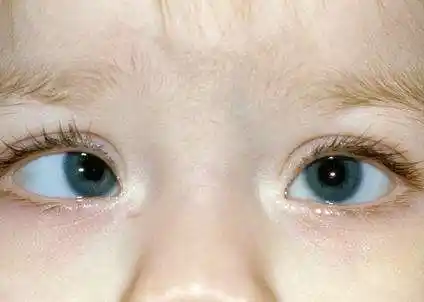 眼睛斜视怎么办 治疗眼睛斜视的方法