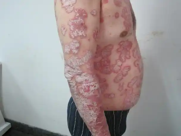 很担心得了牛皮癣会影响生育吗