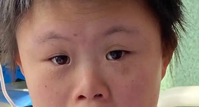 多伦县人民医院儿科成功治愈一名唐氏综合征合并支气管炎患儿