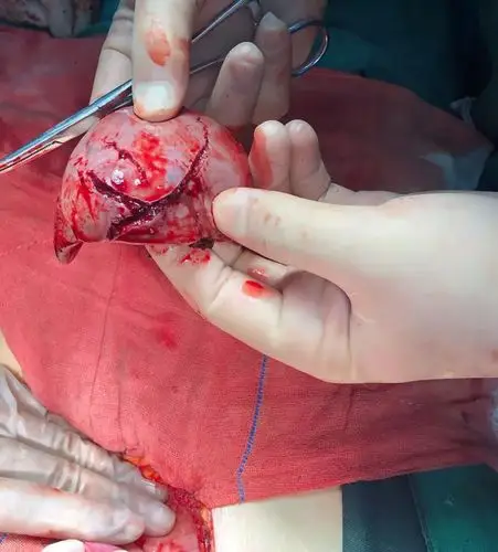 外伤来势凶猛 急救佑护生命---嘉之慧医院急诊救治脾破裂患者