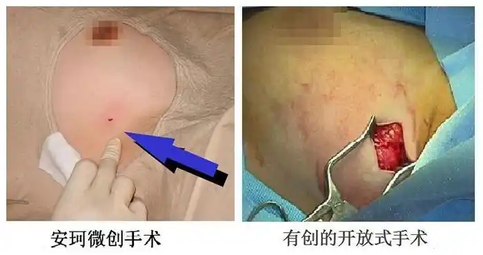 大小在3cm以下的乳腺良性病变,如乳腺纤维腺瘤,乳腺囊肿,乳腺结节等