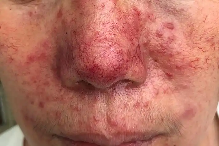 酒糟鼻的临床典型症状有哪些-泉州广肤皮肤病专科_泉州皮肤科哪个医院
