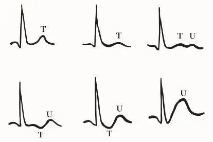 u波心电图图片