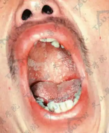 口腔上腭及舌部有成片白色黏附菌块,易刮除