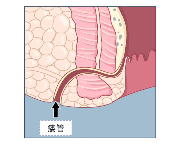 "肛瘘手术,到底有多痛?