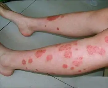 银屑病长什么样图片红斑型牛皮癣症状图片肚子上长癣图片牛皮屑早期