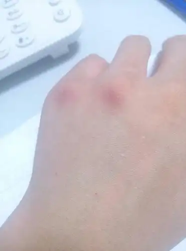 展开全部 血液或者输液用的药渗到了皮下,引起局部水肿最好的方法是