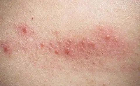 艾滋病的初期皮疹特点_艾滋病初期_女性得艾滋病的初期症状