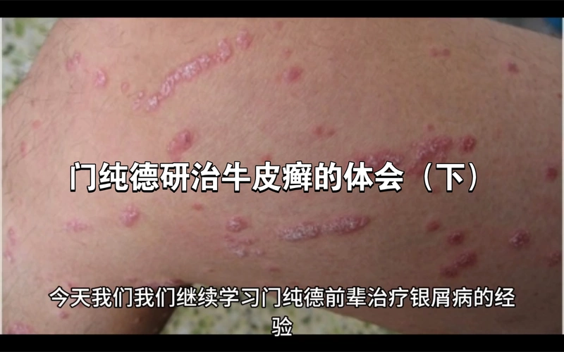 门纯德研治牛皮癣的体会(下)