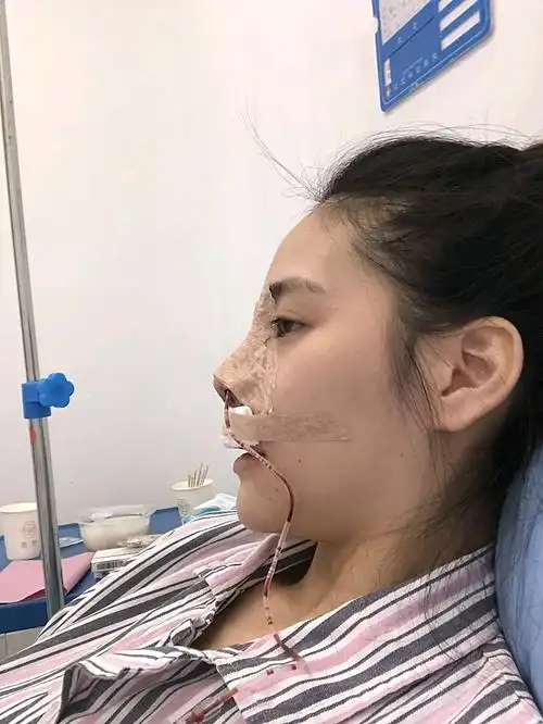 膨体隆鼻术后第一天