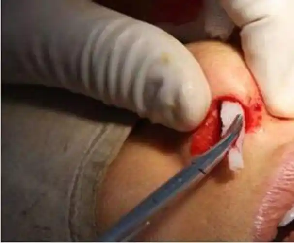 硅胶隆鼻取出假体图片