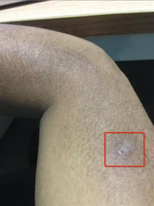 问:手臂外侧的皮肤痒,越来越黑,两边手臂外侧长出图示的黑孢,有点疼