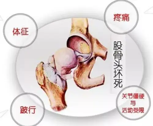 王氏冷敷贴:股骨头坏死的病因与保守治疗