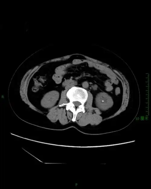 图16  左肾结石