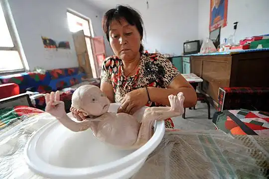 吓!山西智障女子生产无肛婴儿 骨瘦如柴酷似外星人