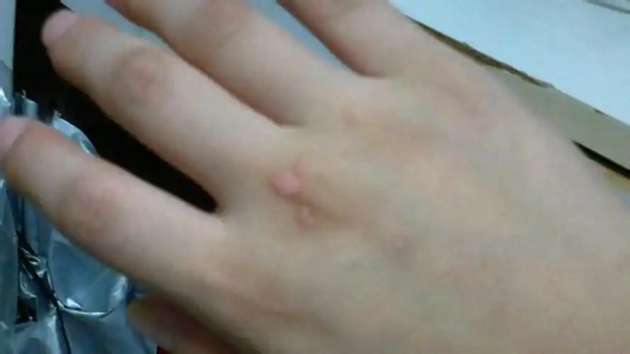 手背寻常疣图片