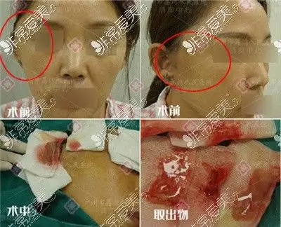 奥美定取出算大手术吗揭秘国内奥美定超新取出方法