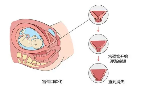 如何判断宫颈口软化了