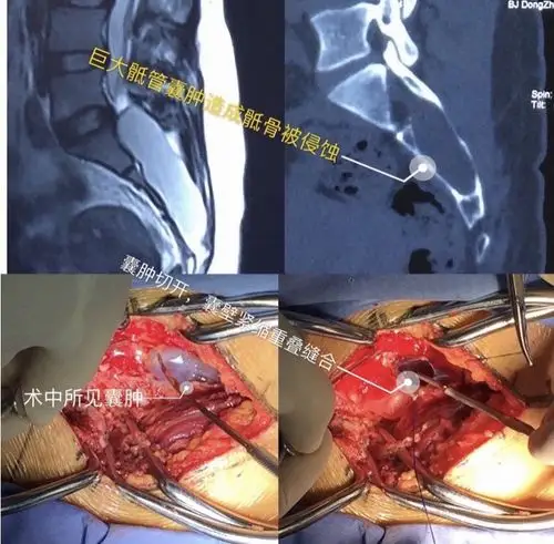 骶管囊肿的诊治_骶管囊肿_介绍_症状表现_检查_治疗方式 - 好大夫在线