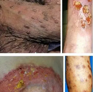 成都男性梅毒的典型症状图片