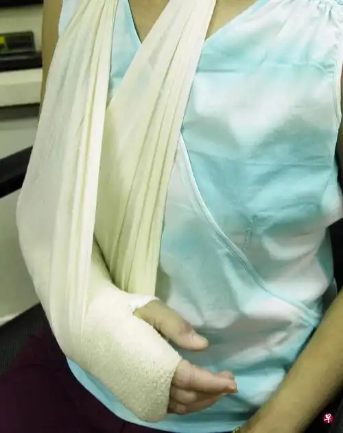 骨折后患处一般需包石膏.(档案照)