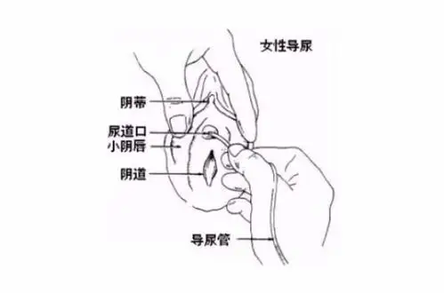 间歇性导尿患者的健康教育