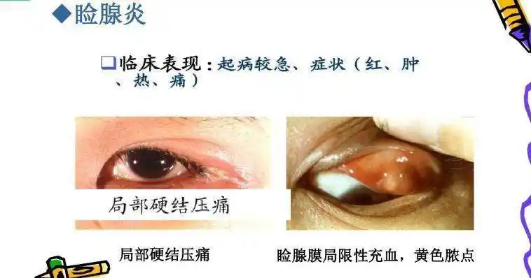 图文:麦粒肿与霰粒肿鉴别_防控_儿童_屈光