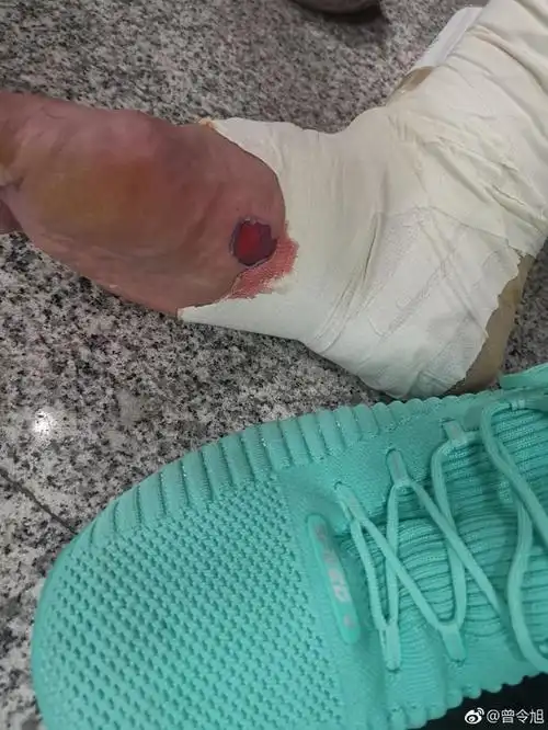 看着都疼〖出了〗!曾令旭赛后展示脚部伤口≤血染≥ 血染红袜子