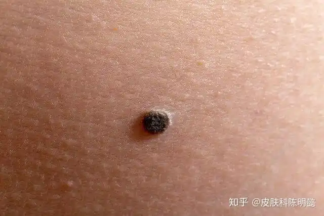 黑色素瘤什么样子怎么办