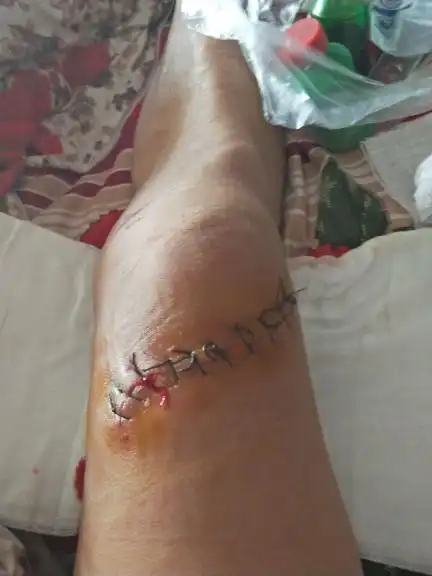 我在厂里上班受伤了,右大腿肌肉打烂了缝了10针,厂里会陪钱吗?