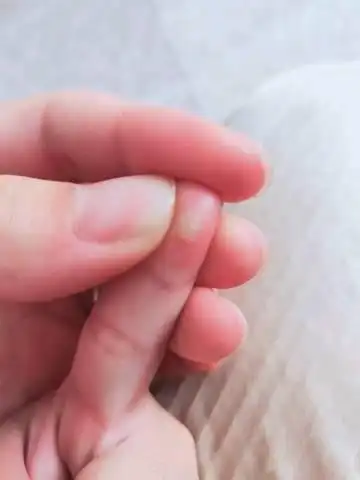 宝宝四岁,食指手指上长了一个白色的硬疙瘩怎么回事