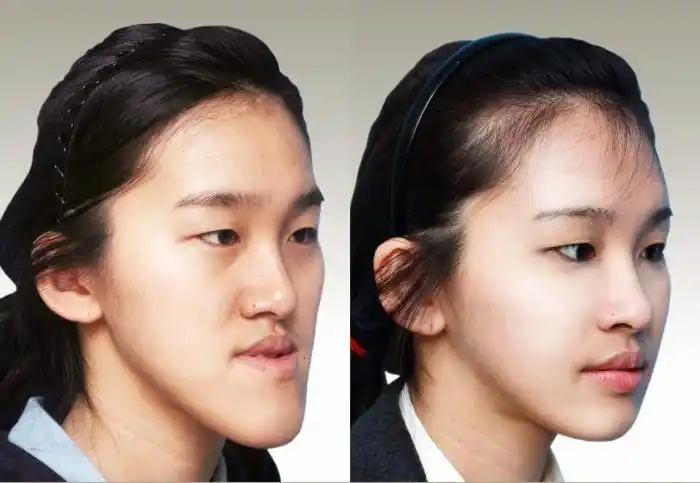 鞋拔子是什么鞋拔子脸也是一种病