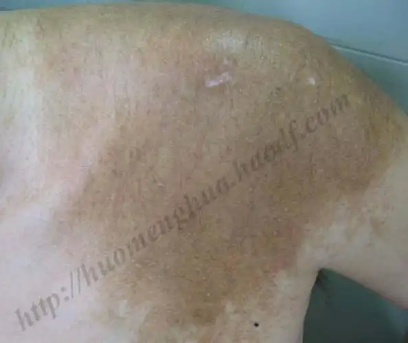 becker痣多毛_霍孟华医生文章_中国医学科学院整形外科医院-微医