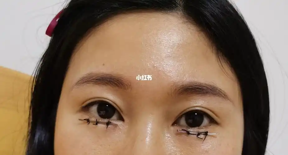 倒睫手术第五天