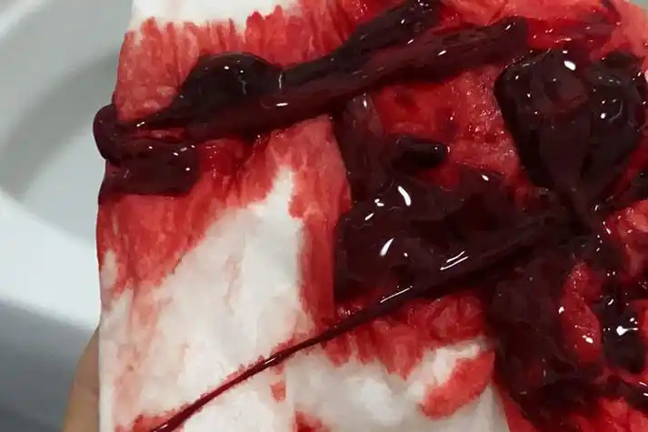 先兆流产出血带褐色分泌物图