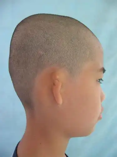 外耳二科典型病例二