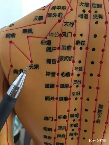 拔罐调理病症之~落枕